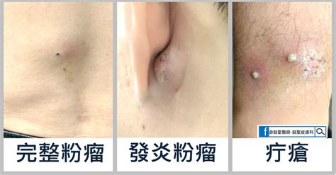 臉上釘子|疔瘡是什麼？「疔子」會自己好嗎？與痘痘、粉瘤4大。